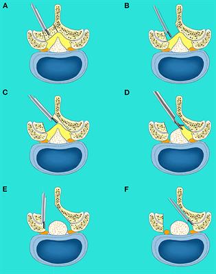 Comparison of Clinical Outcomes Following Lumbar Endoscopic Unilateral Laminotomy Bilateral Decompression and Minimally Invasive Transforaminal Lumbar Interbody Fusion for One-Level Lumbar Spinal Stenosis With Degenerative Spondylolisthesis